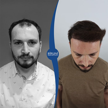 Slider image (2) Biruni Hair Institute